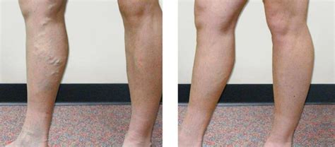 Vein Screening Is Important For Detection And Treatment Of Vein Disorders
