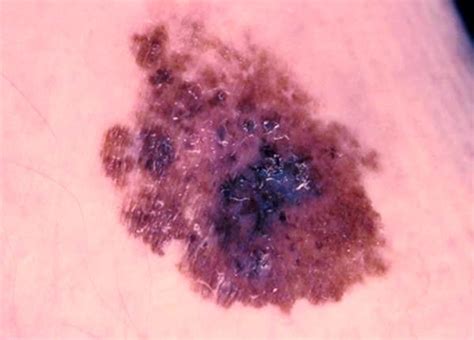 Malign melanom (kötü huylu cilt tümörü), üç tip deri kanseri içinde en ciddi olanıdır. Modermærkekræft (malignt melanom) - Patienthåndbogen på ...