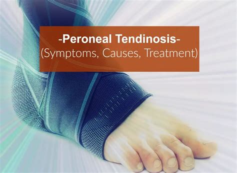Peroneal Tendonitis Symptoms Treatments Spine Orthopedic Center My Xxx Hot Girl