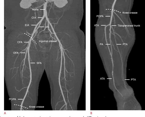 Lower Limb Arteries Lower Limb Ct Angiography Anatomy Radiology Hot Sex Picture