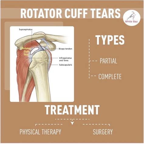 Rotator Cuff Tears You Can Get Back To Normal Even With A Full Rotator Cuff Tear