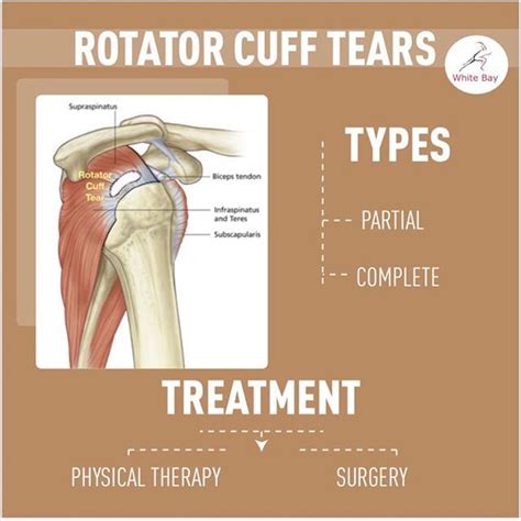 Rotator Cuff Tears You Can Get Back To Normal Even With A Full Rotator