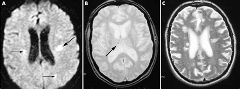 Are Multiple Acute Small Subcortical Infarctions Caused By Embolic