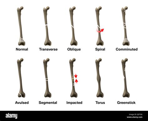 All Types Of Bone Fractures Stock Photo Alamy