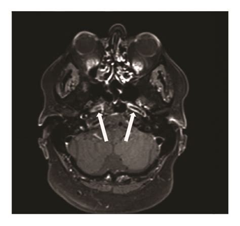 Magnetic Resonance Images Of The Affected Arteries High Grade Stenosis