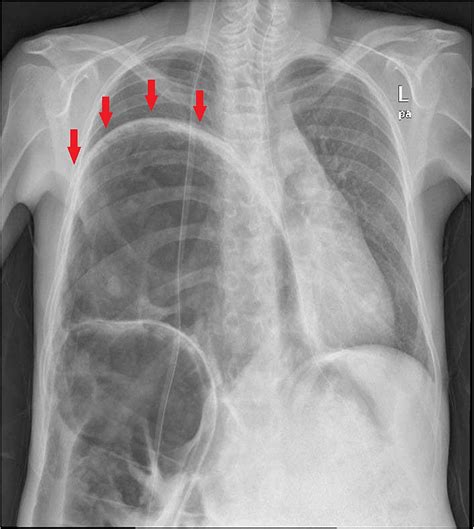 Chest Radiography Shows An Excessive Right Diaphragmatic Eventration