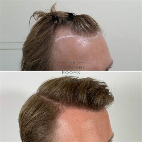 Hair Transplant Timeline What To Expect Treatment Rooms