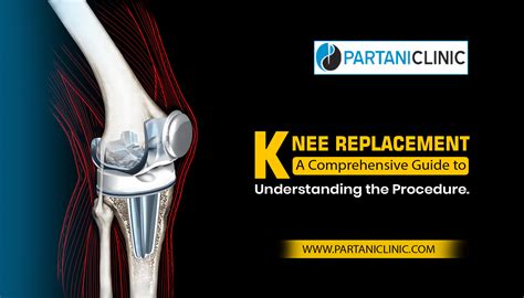 Knee Replacement Surgery Guide Comprehensive Guide Partani Clinic