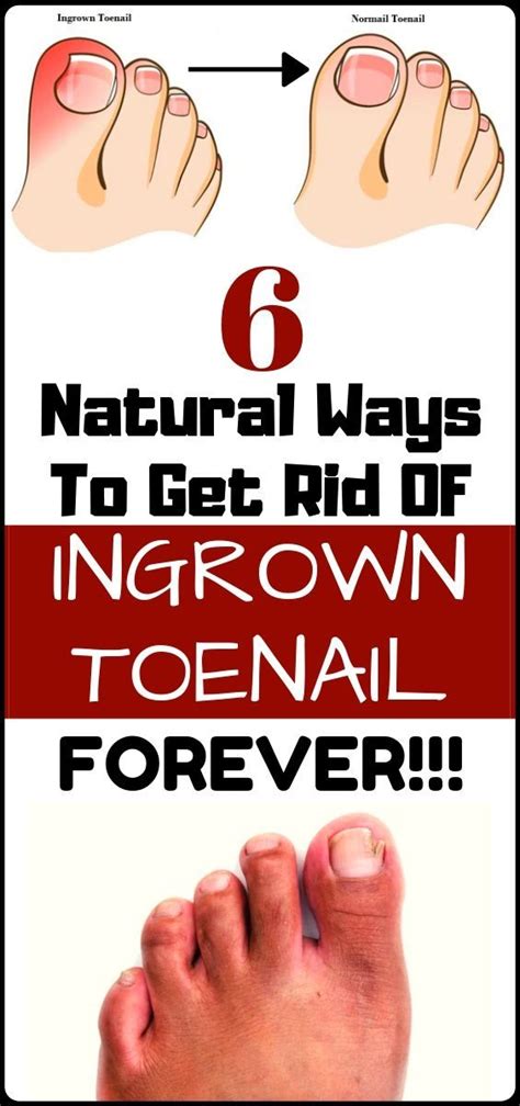 6 Effective Home Remedies To Get Rid Of An Ingrown Toenail Wellness