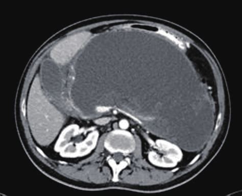 An Axial Computed Tomography Scan Of The Upper Abdomen Showing A Huge