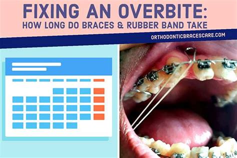 How Long Do Braces And Rubber Band Take To Fix Overbite Orthodontic