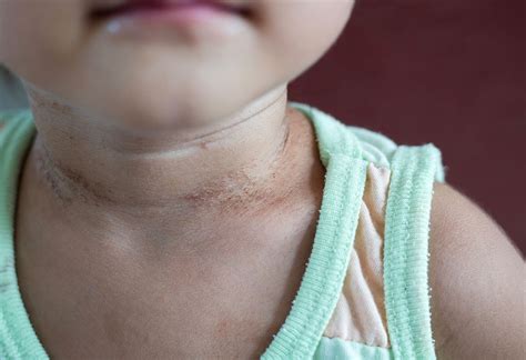 Neck Rash In Babies Reasons Symptoms Treatment And Home Remedies
