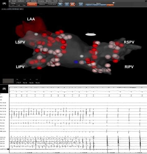 A Electroanatomical Mapping Of Atrial Fibrillation Ablation Carto