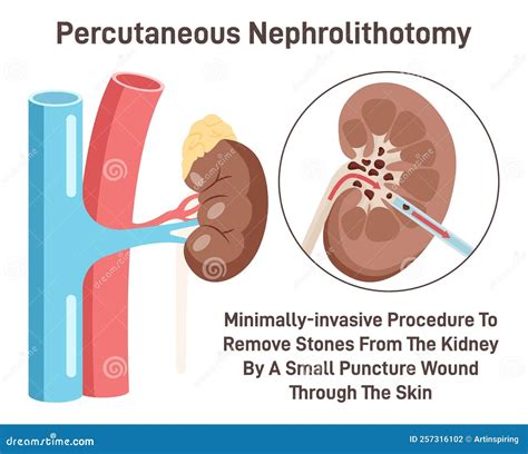 Percutaneous Nephrolithotomy Kidney Stone Removing Surgery Stock