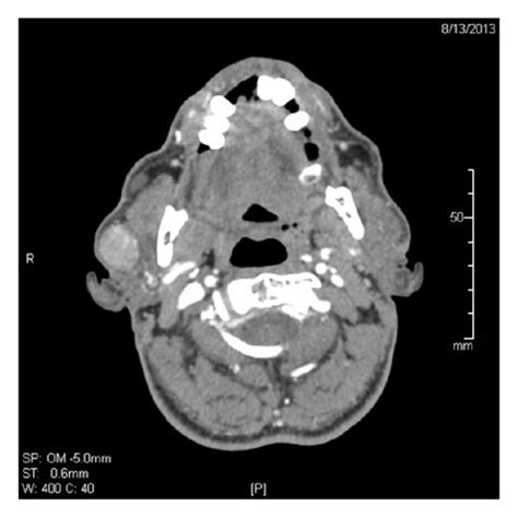 Ct Neck Axial Cut Postcontrast Soft Tissue Window Well Defined