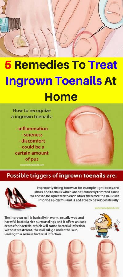 Here Are 5 Remedies To Treat Ingrown Toenails At Home Way To Steal