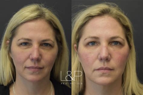 Facial Fillers Before And After Photos Case 80 Palo Alto And San Jose California Landp Aesthetics