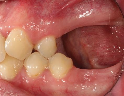 Bone Grafting After Tooth Removal Why When And What To Use Dental