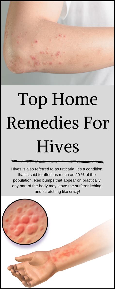 Top Home Remedies For Hives Hives Remedies Home Remedies For Hives