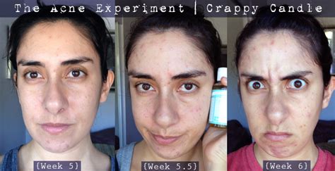 Dr Bronners Review The Acne Experiment Crappy Candle