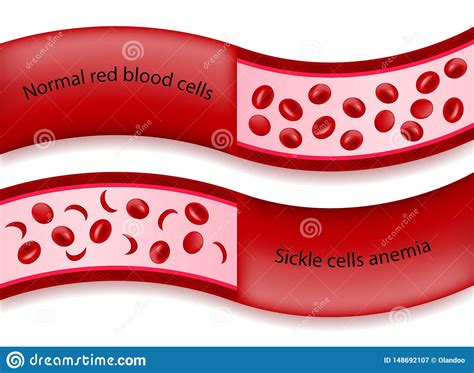 Comparison Between Normal Red Blood Cells And Sickle Cells
