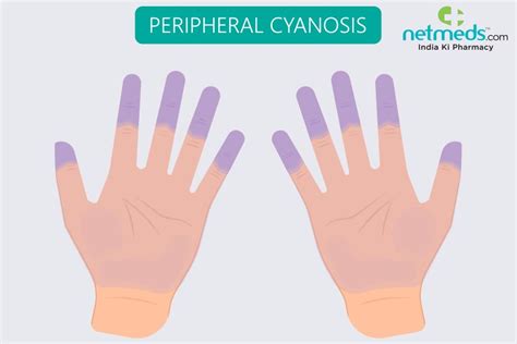 Peripheral Cyanosis Causes Symptoms And Treatment