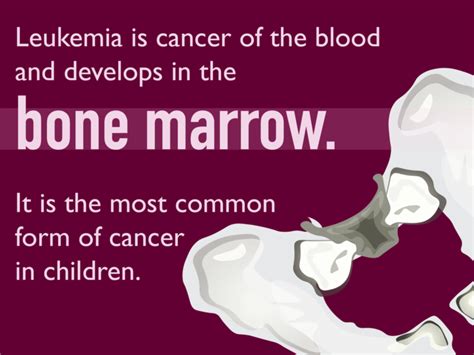 Pediatric Leukemia Symptoms And Signs Dana Farber Cancer Institute
