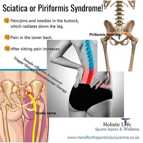 Piriformis Muscle Gluteal Muscles Sacroiliac Sciatic Pain Core Hot Sex Picture
