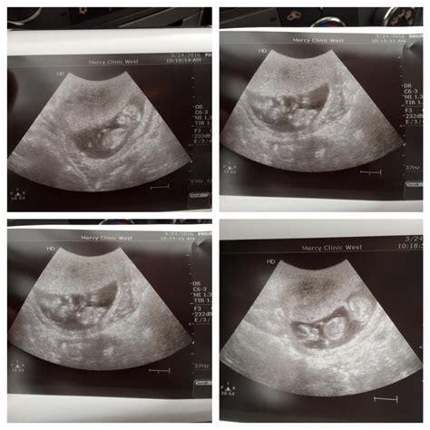 Gender Prediction Of Twins 13 Weeks Today
