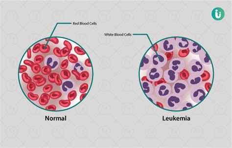 Blood Cancer Symptoms Causes Treatment Medicine Prevention Diagnosis