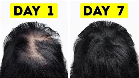 7 Days Hair Regrowth Guaranteed Naturally Regrowth Long Thick