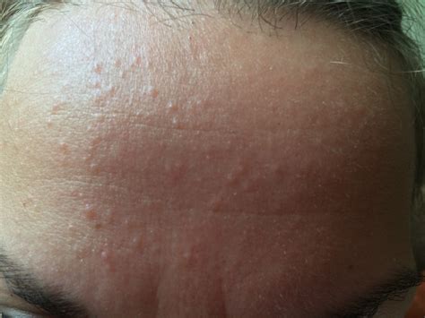 Raised Red Bumps On Skin Pictures Photos