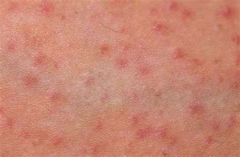 Folliculitis And Acneiform Dermatoses Allergykb