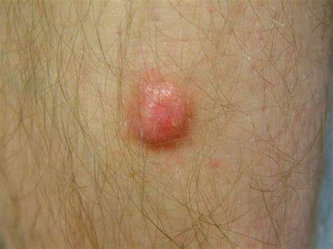 Dermatofibroma Treatment Pictures Removal Causes