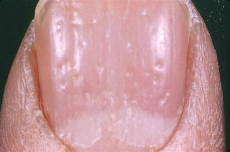 Pictures Of Psoriatic Arthritis What It Looks Like