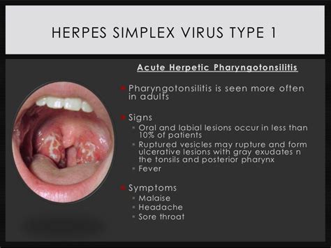 Disease State Presentation Herpes Simplex Virus