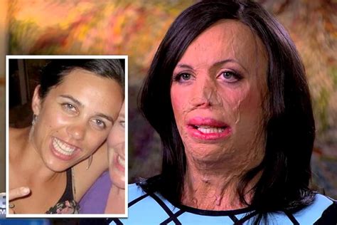 What Exactly Happened To Turia Pitt Her Accident Details Before And After Burns Photos News