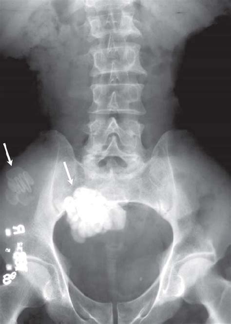 Plain Abdominal Radiograph Of A Patient With Subacute Intestinal