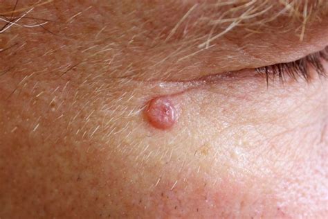 First Immunotherapy For Advanced Basal Cell Carcinoma Approved In Us