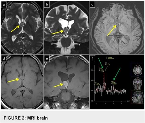 Figure 1 From A Rare Case Of Choroid Plexus Papilloma Of The Third