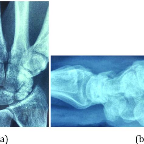 Intraoperative Views Of Scaphoid Sclerotic Lesion A Of The Scaphoid