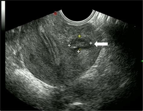 frontiers ultrasound guided transvaginal aspiration and sclerotherapy for uterine cystic