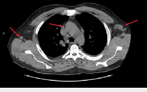 Ct Scan Of Chest Showing Bilateral Enlarged Axillary