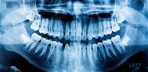 Oral And Dental X Rays Xrays Of Teeth Burlington Britannia Dental Centre