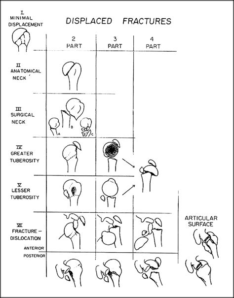 Training Improves Agreement Among Doctors Using The Neer System For Proximal Humeral Fractures