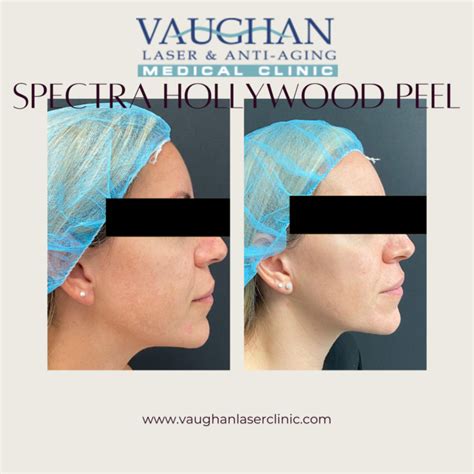 Spectra Hollywood Laser Peel Vaughan Laser And Anti Aging Medical Clinic