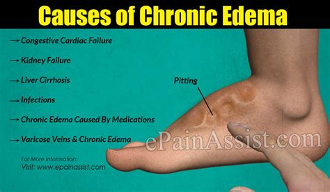 Edema Is Swelling Caused By Pathologists Lancet Kenya Facebook