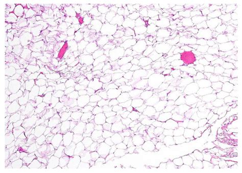 Diagnostics Free Full Text Thyroglossal Duct Lipoma A Case Report