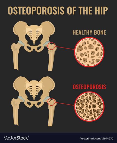 Osteoporosis Hip Royalty Free Vector Image Vectorstock