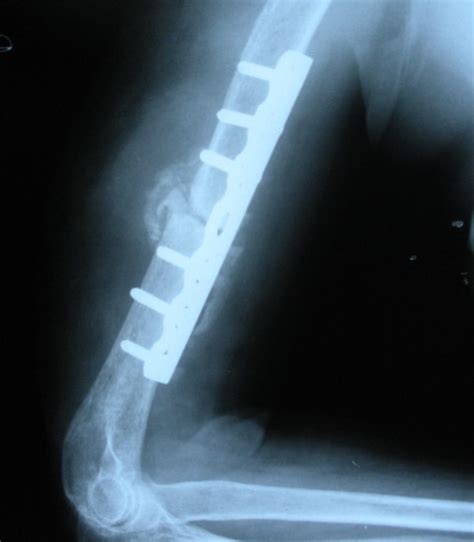 Xrays Of Fracture Of Humerus Bone And Spine